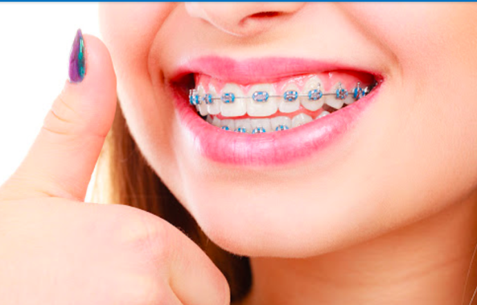 Diş Sağlığı ve Diş Teli İlişkisi Nedir?
